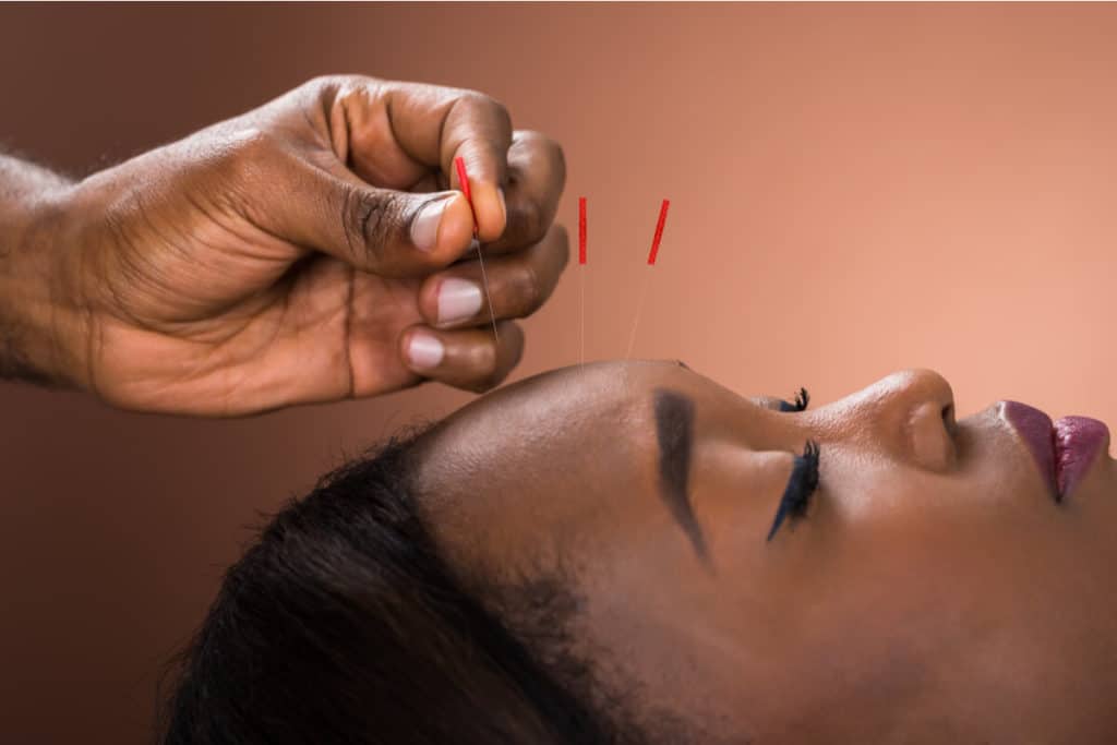 close up of person's face getting acupuncture