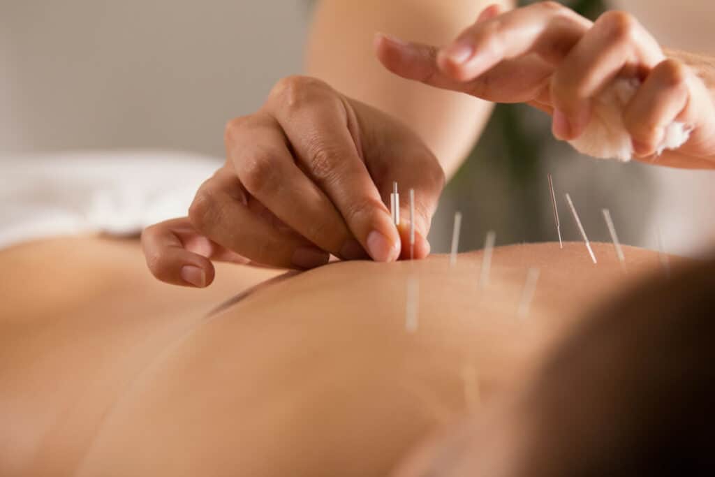 10 health benefits of acupuncture